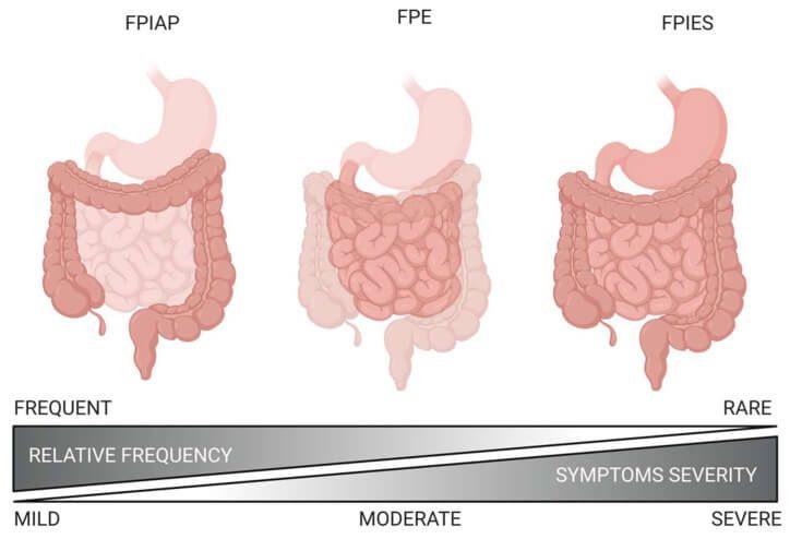 Diagram of the affected regions of the gastrointestinal tract for different food allergies.