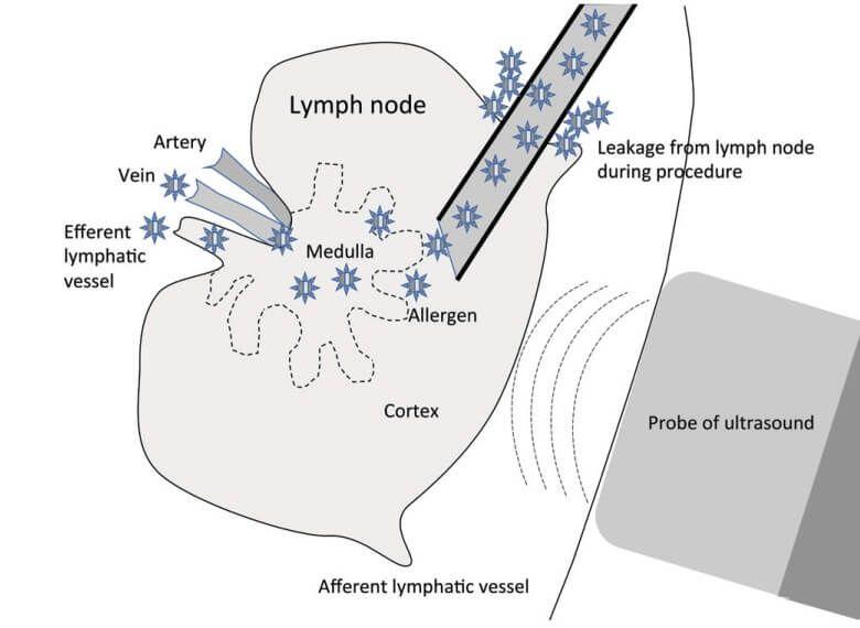 Diagram of a lymph node being injected.